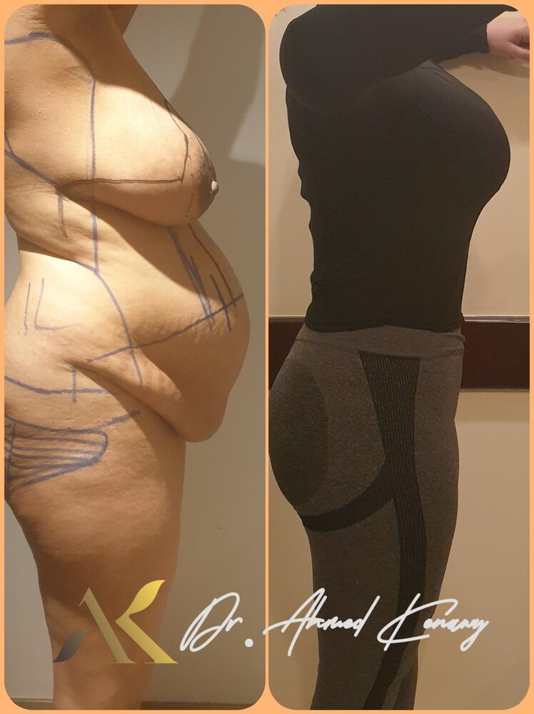 Before and After Result